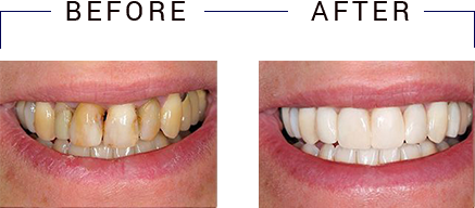 Rahway Family Dental   Orthodontics | Dental Cleanings, Implant Dentistry and Fluoride Treatment